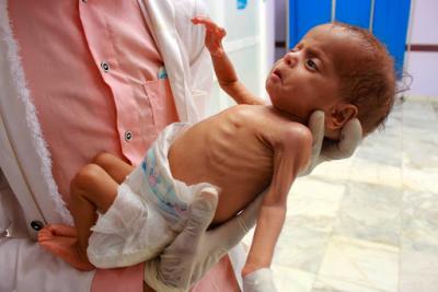 المؤتمر نت - حذرت وكالات الأمم المتحدة اليوم الجمعة من أن نصف أطفال اليمن ممن هم دون سن الخامسة سيعانون من سوء التغذية هذا العام