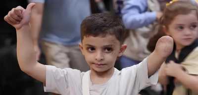 المؤتمر نت - أعلنت وزارة الصحة في غزة، اليوم، تسجيل 6 آلاف حالة بتر أطراف خلال عامين من حرب الإبادة الإسرائيلية على القطاع